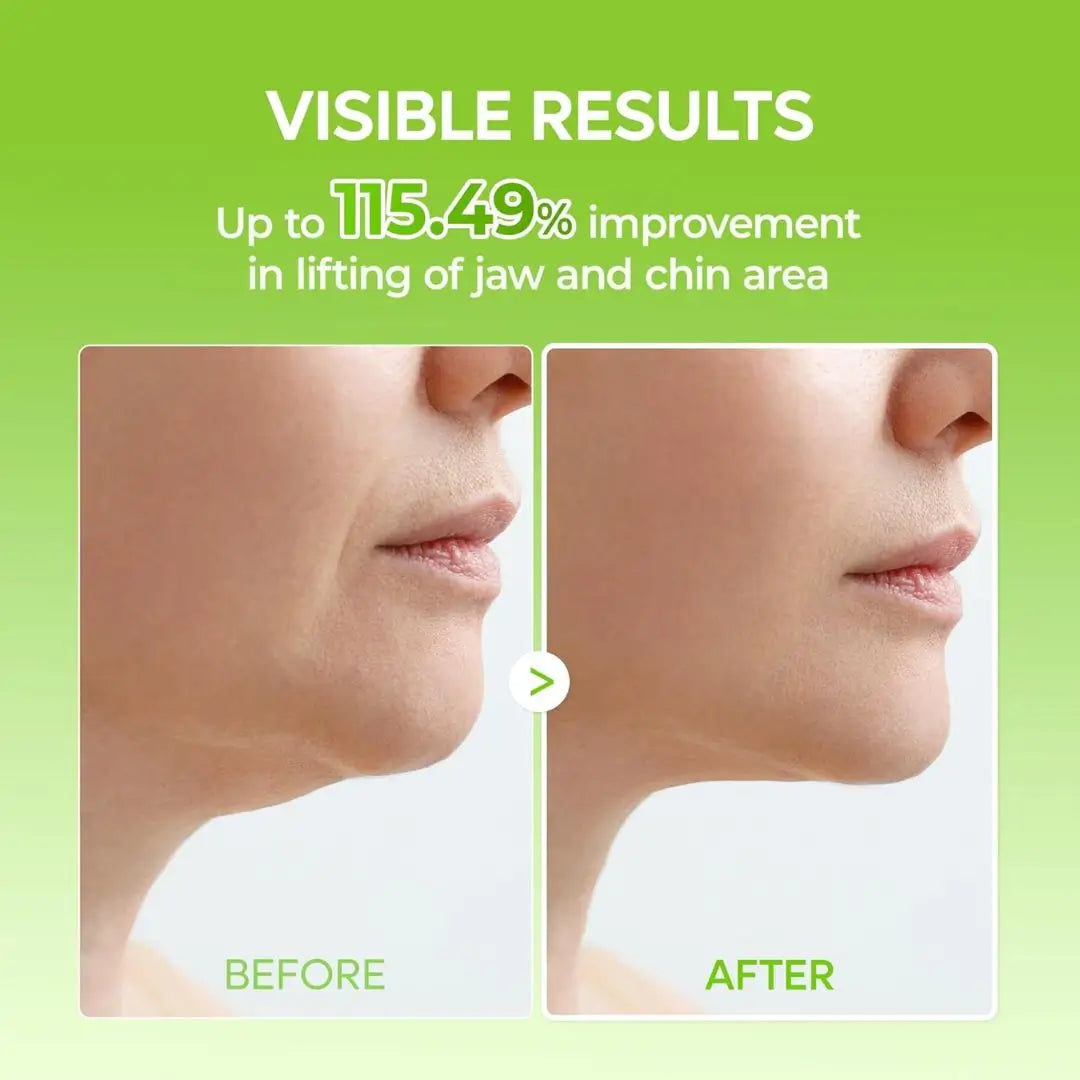 CactoLift™ – Tecnología Fría de Reafirmación Facial